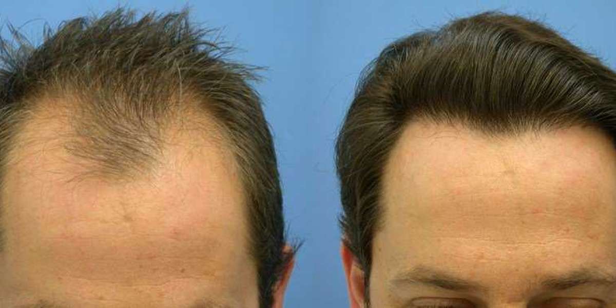 Hair Restoration For Men Beverly Hills