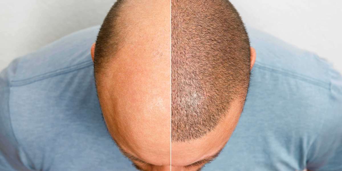 Exploring Hair Transplant Costs in Delhi: What You Need to Know