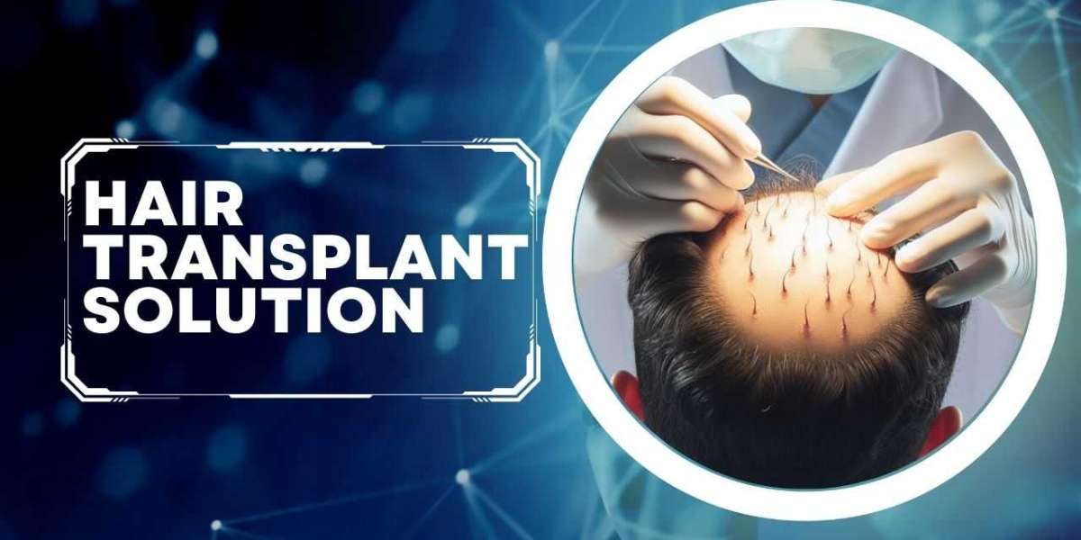Discovering the Best Hair Transplant Solutions