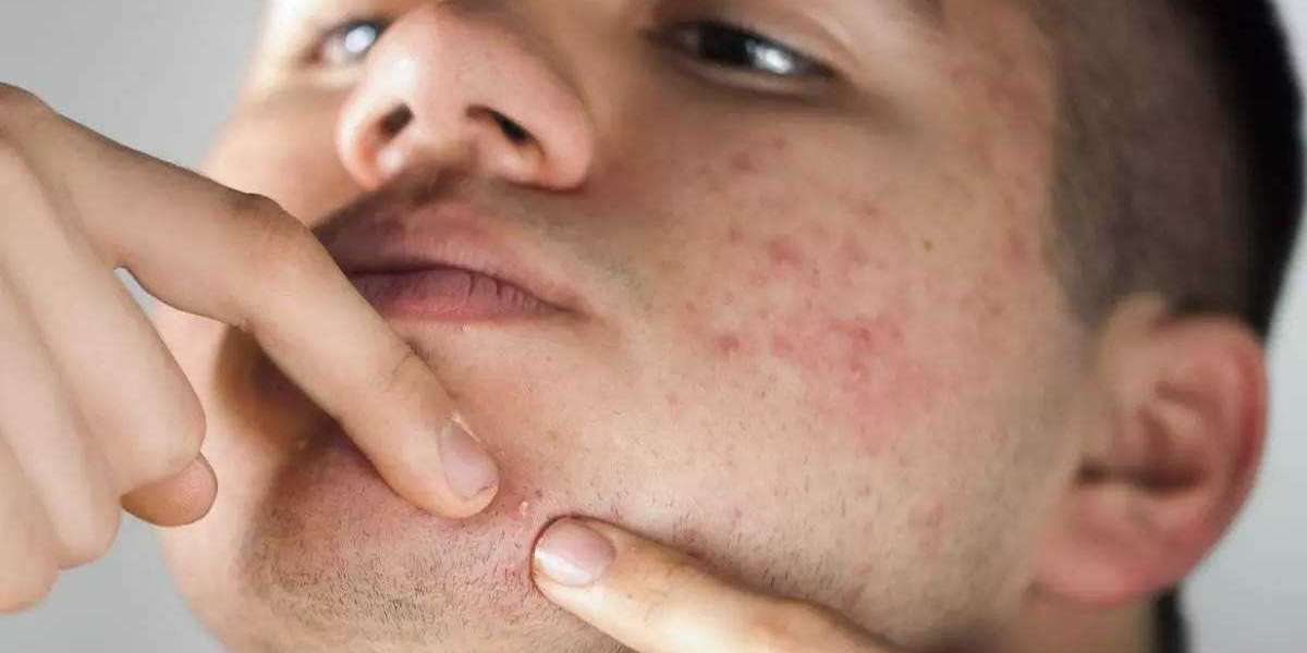 How Does Acne Be Treated with Retin-A (Tretinoin)?