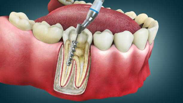 How Root Canal Treatment Can Relieve Pain and Save Your Tooth