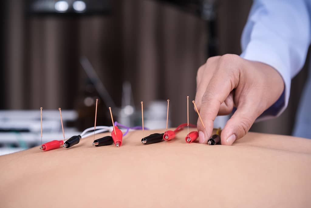 Acupuncture Frequency & Benefits: How Often for Best Results?